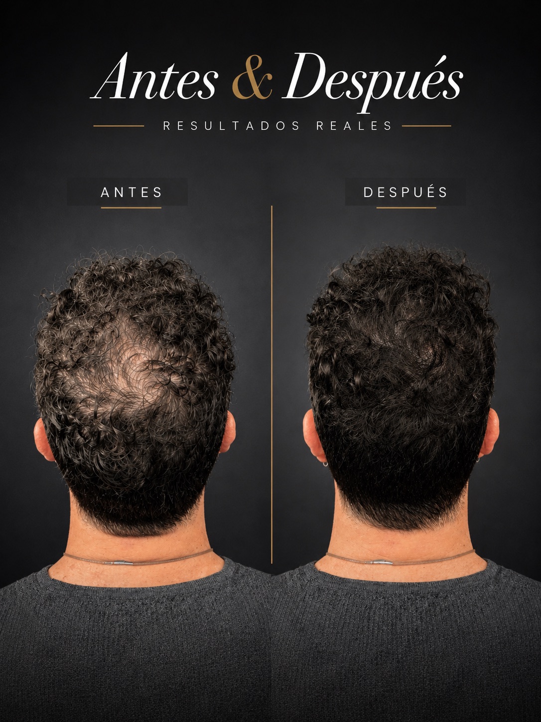 Resultado micropigmentación 3